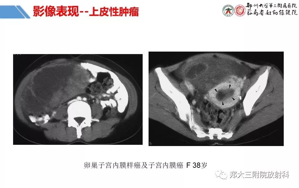 【PPT】卵巢肿瘤的影像诊断思路