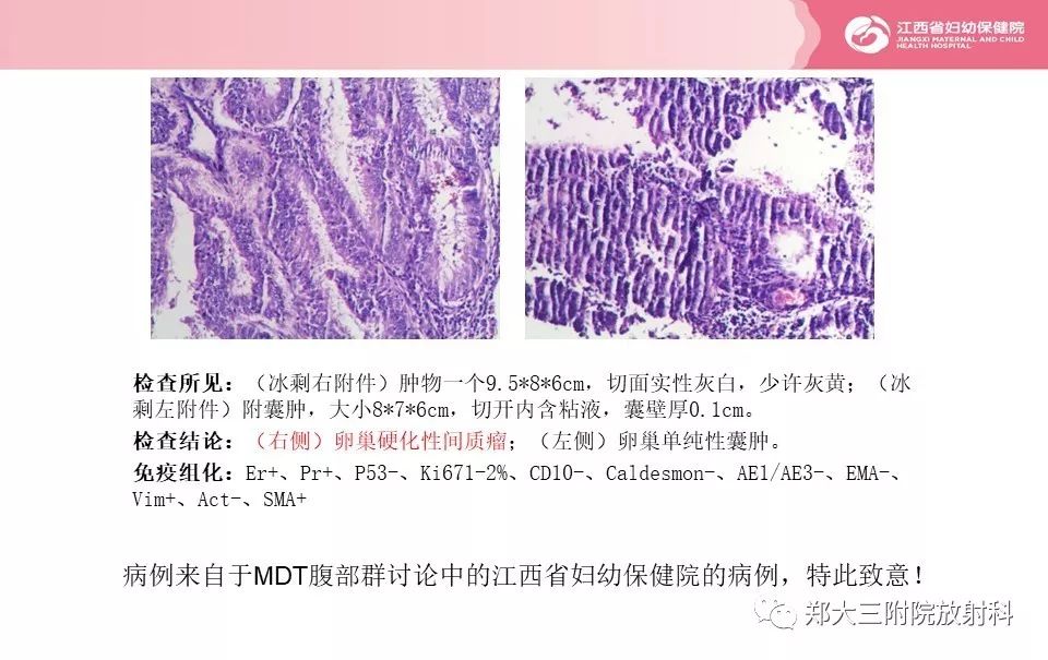 【PPT】卵巢肿瘤的影像诊断思路
