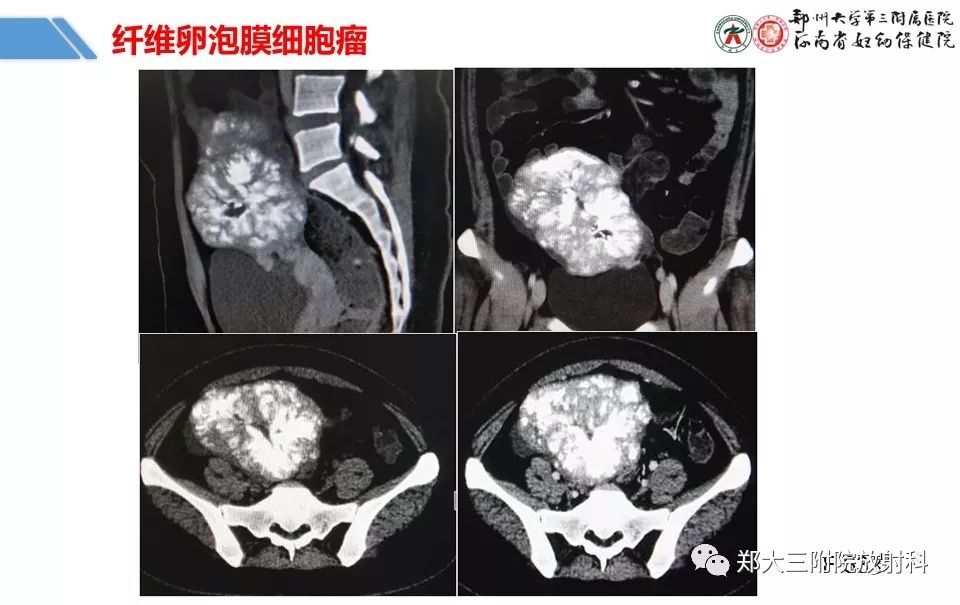 【PPT】卵巢肿瘤的影像诊断思路