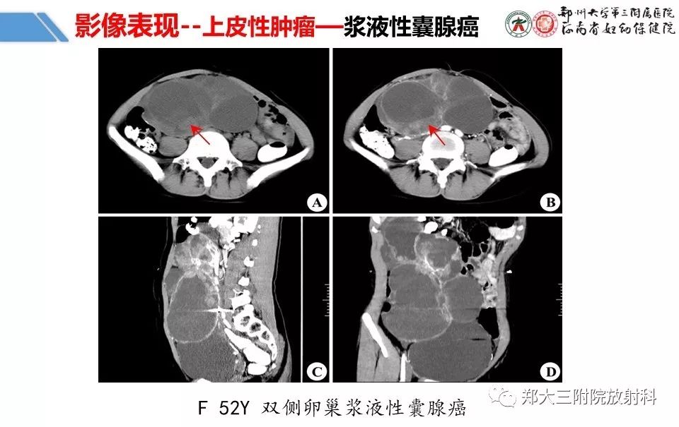 【PPT】卵巢肿瘤的影像诊断思路