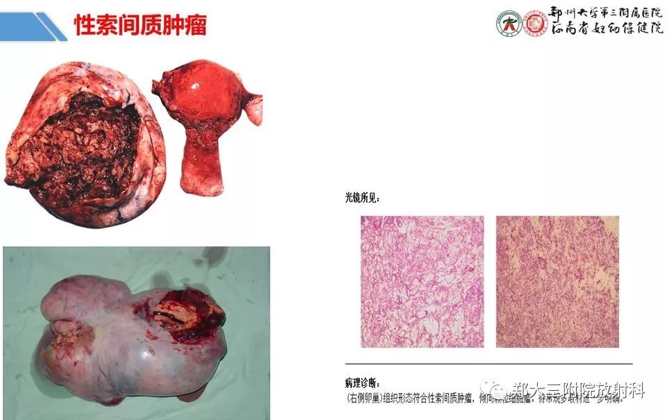 【PPT】卵巢肿瘤的影像诊断思路