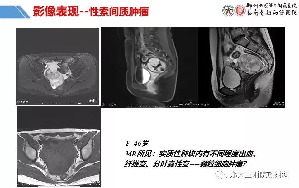 【PPT】卵巢肿瘤的影像诊断思路