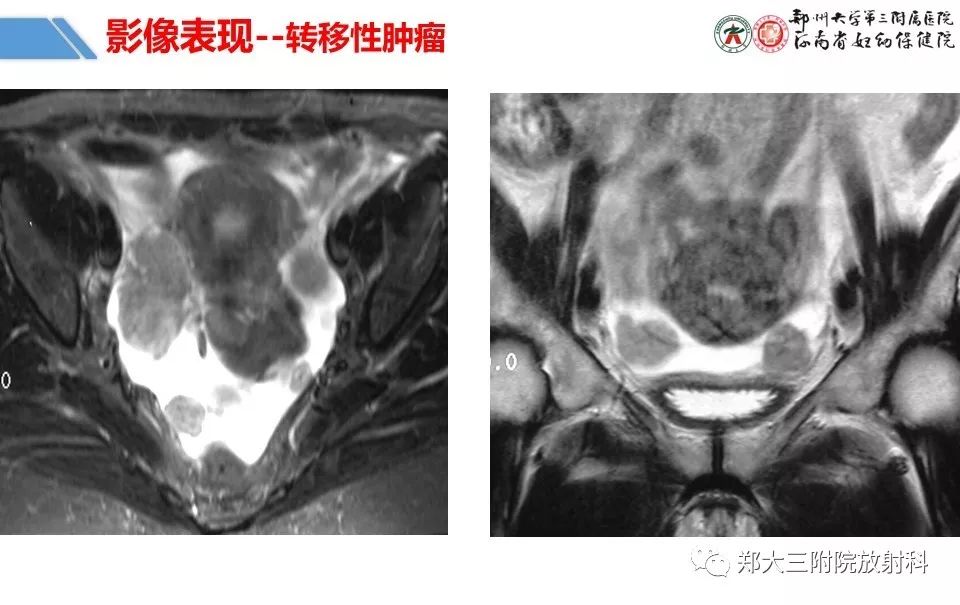 【PPT】卵巢肿瘤的影像诊断思路