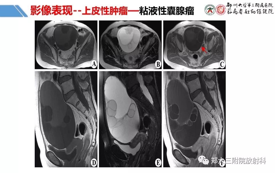 【PPT】卵巢肿瘤的影像诊断思路