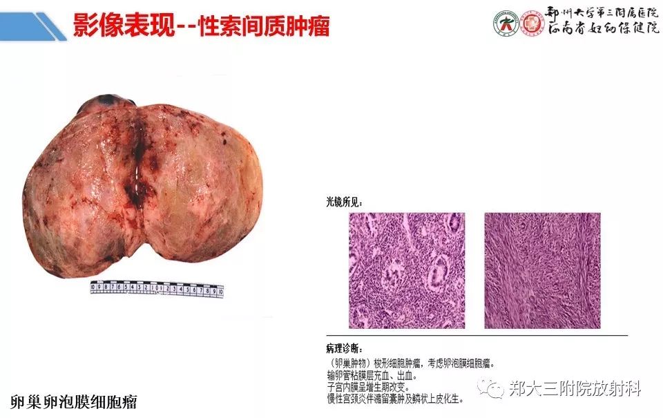 【PPT】卵巢肿瘤的影像诊断思路
