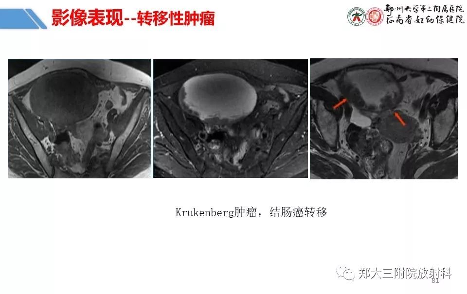 【PPT】卵巢肿瘤的影像诊断思路