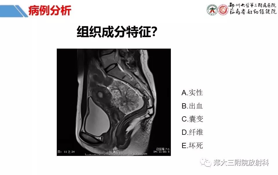 【PPT】卵巢肿瘤的影像诊断思路