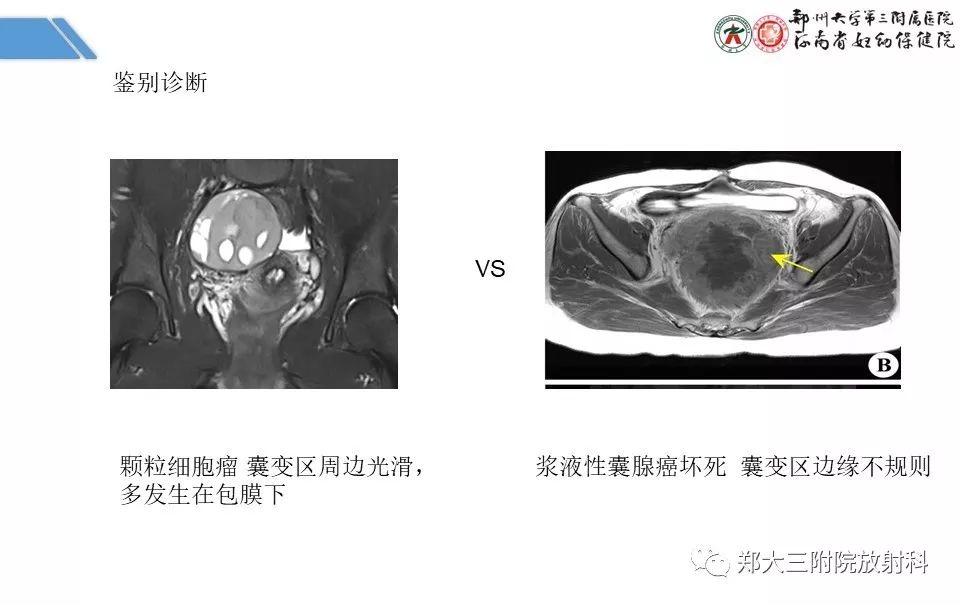 【PPT】卵巢肿瘤的影像诊断思路