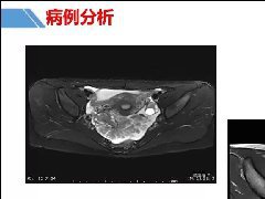 卵巢肿瘤的影像诊断思路