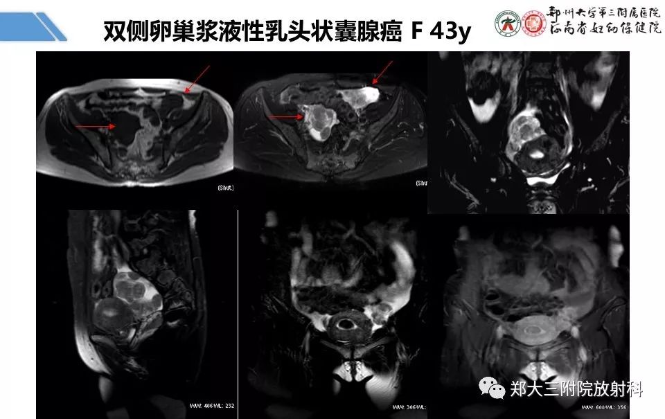 【PPT】卵巢肿瘤的影像诊断思路
