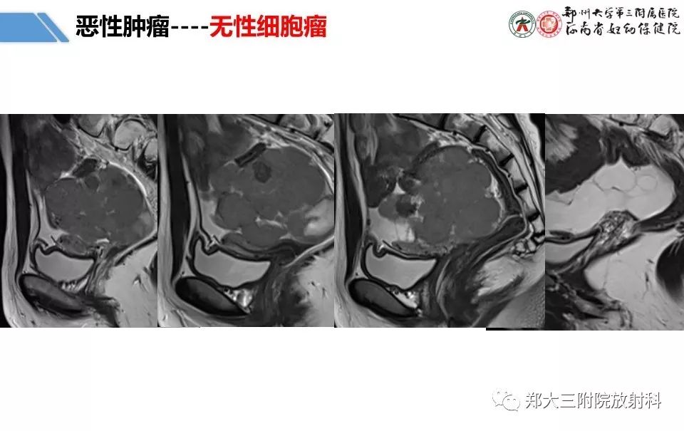 【PPT】卵巢肿瘤的影像诊断思路