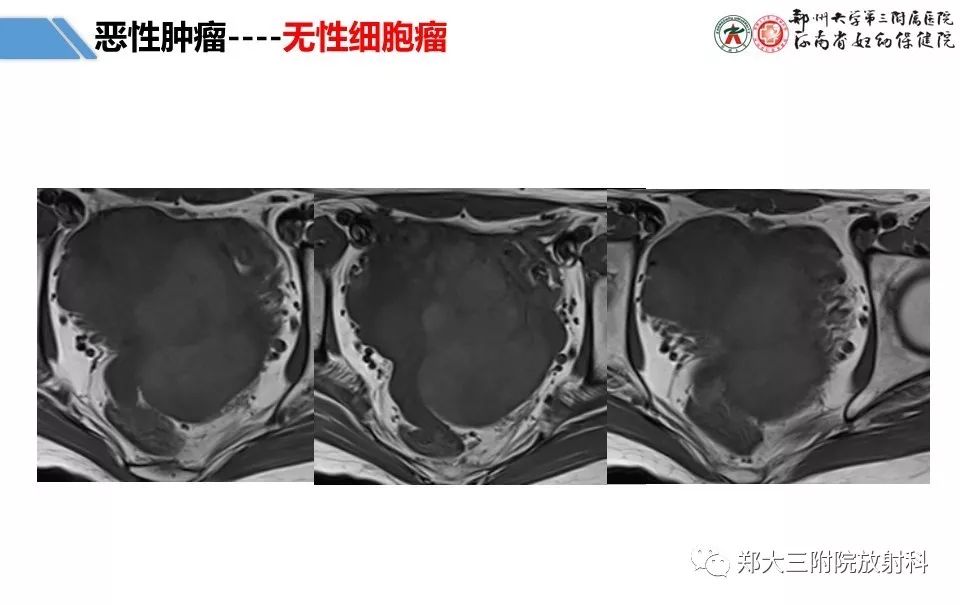 【PPT】卵巢肿瘤的影像诊断思路