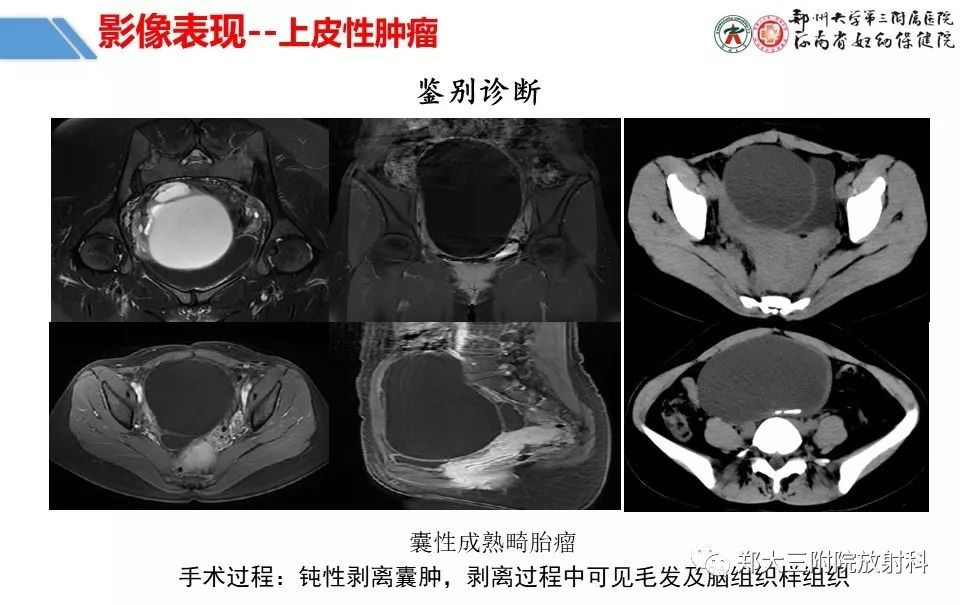 【PPT】卵巢肿瘤的影像诊断思路