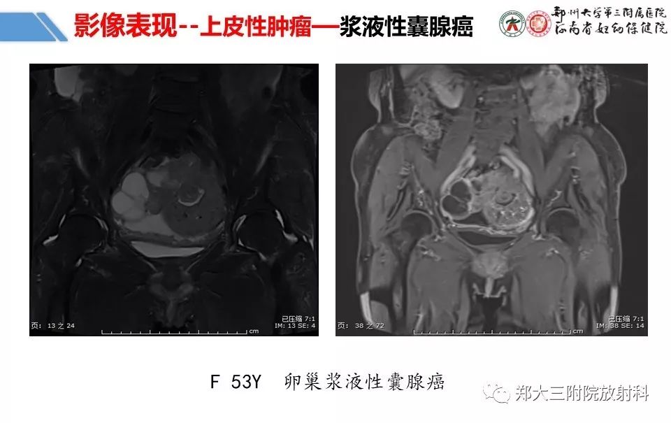 【PPT】卵巢肿瘤的影像诊断思路