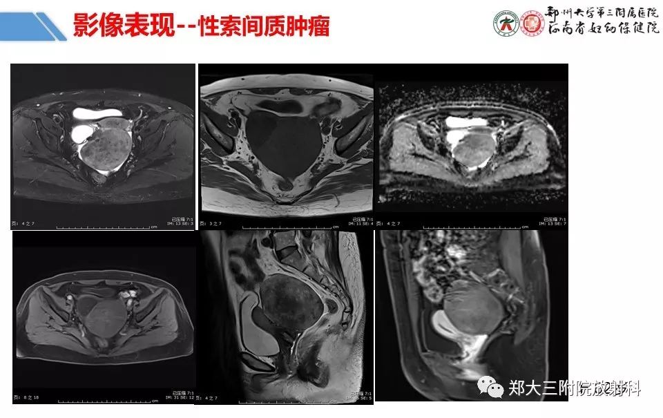 【PPT】卵巢肿瘤的影像诊断思路