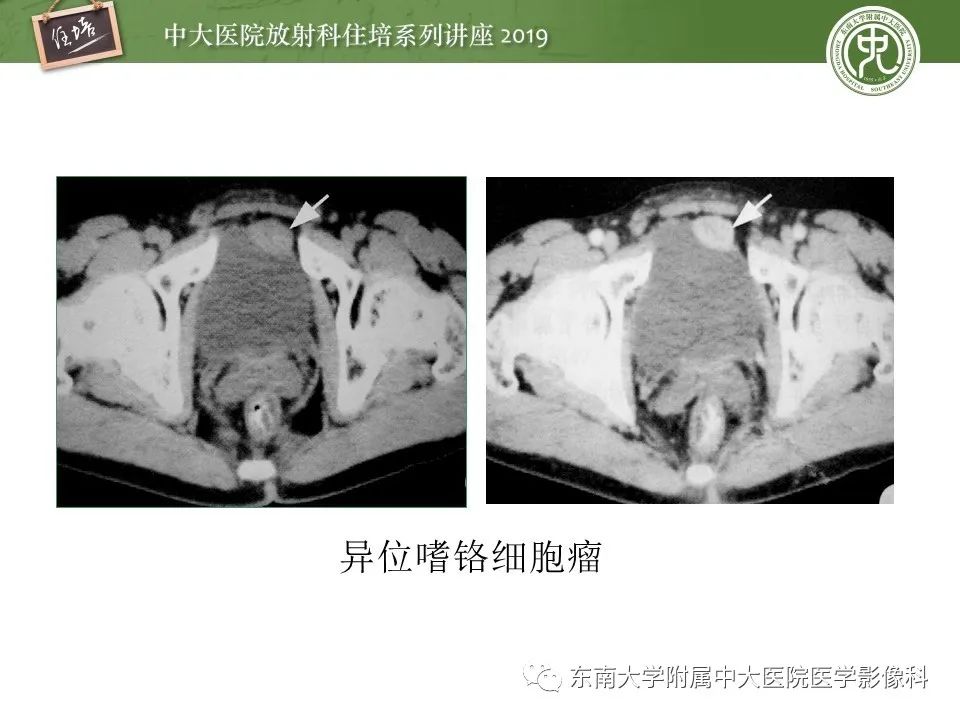 【PPT】肾上腺病变临床与影像思路分析