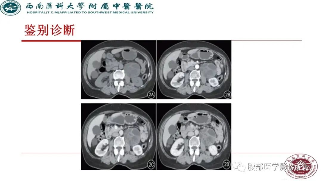 【病例】髂窝淋巴结炎性假瘤1例CT及MR影像诊断