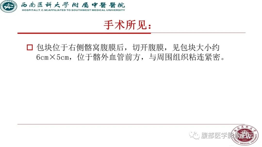 【病例】髂窝淋巴结炎性假瘤1例CT及MR影像诊断