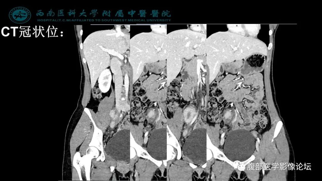【病例】髂窝淋巴结炎性假瘤1例CT及MR影像诊断