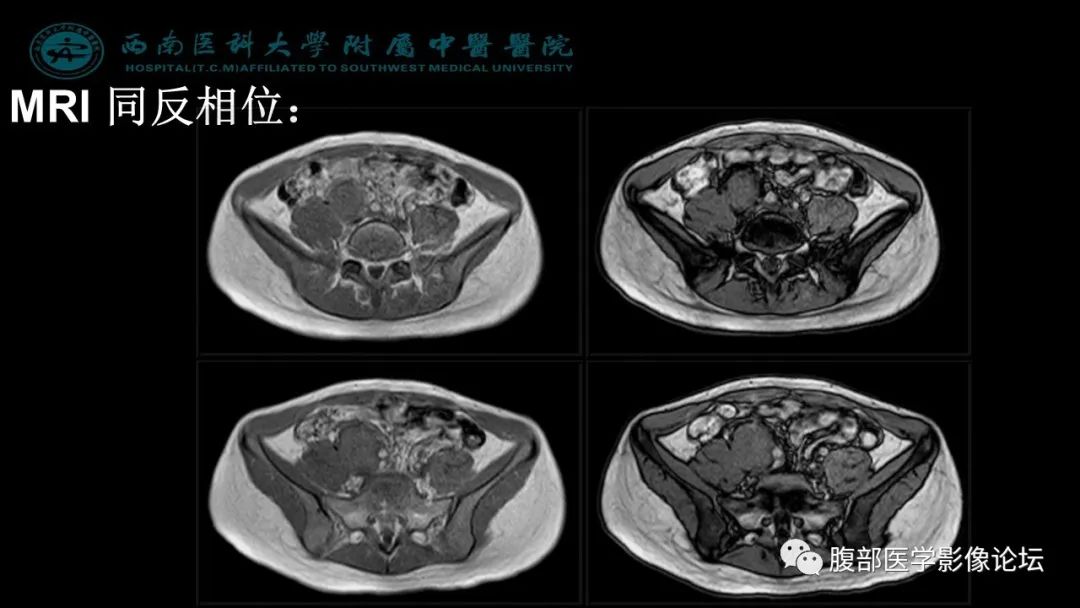 【病例】髂窝淋巴结炎性假瘤1例CT及MR影像诊断