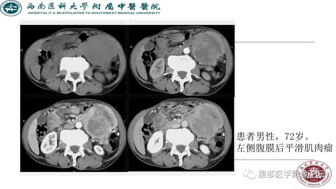 【病例】髂窝淋巴结炎性假瘤1例CT及MR影像诊断