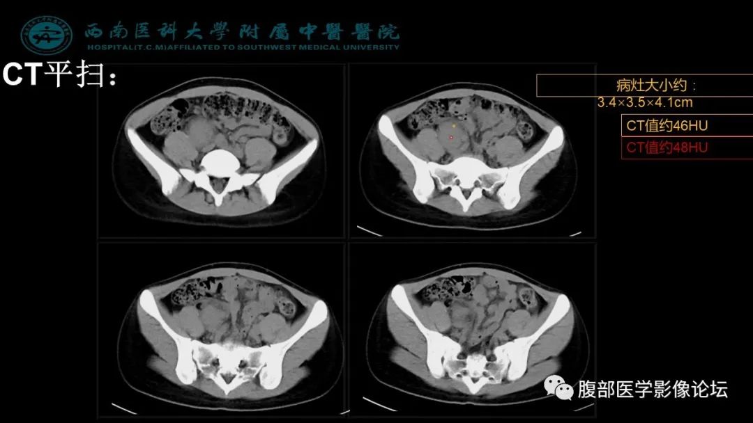 【病例】髂窝淋巴结炎性假瘤1例CT及MR影像诊断