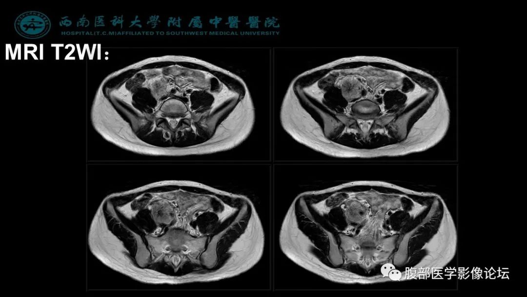 【病例】髂窝淋巴结炎性假瘤1例CT及MR影像诊断