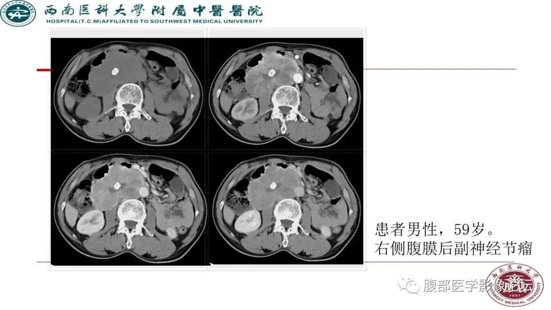 【病例】髂窝淋巴结炎性假瘤1例CT及MR影像诊断
