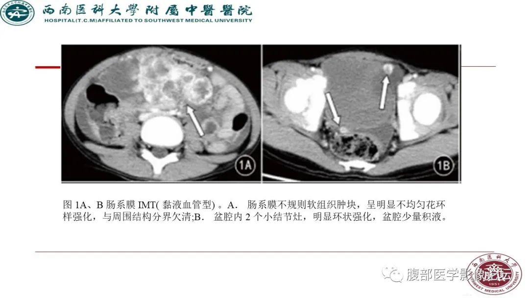 【病例】髂窝淋巴结炎性假瘤1例CT及MR影像诊断