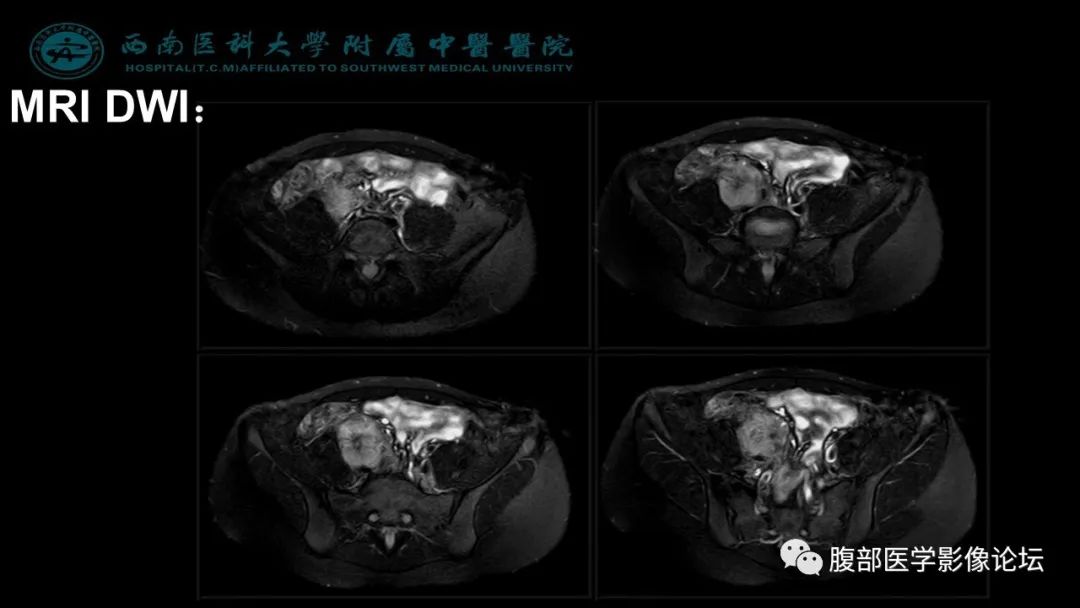 【病例】髂窝淋巴结炎性假瘤1例CT及MR影像诊断