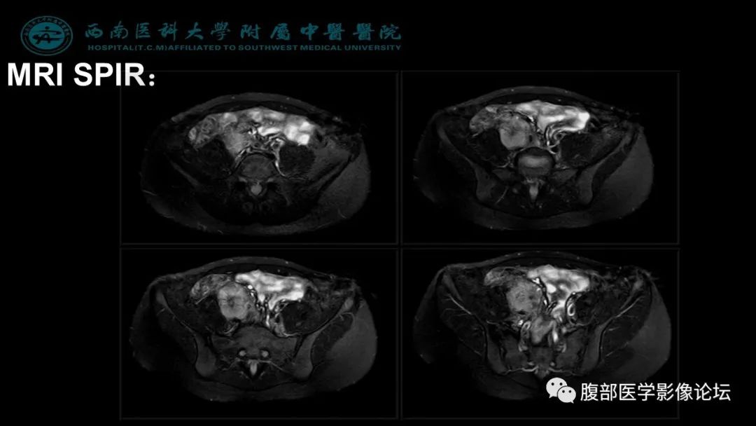 【病例】髂窝淋巴结炎性假瘤1例CT及MR影像诊断