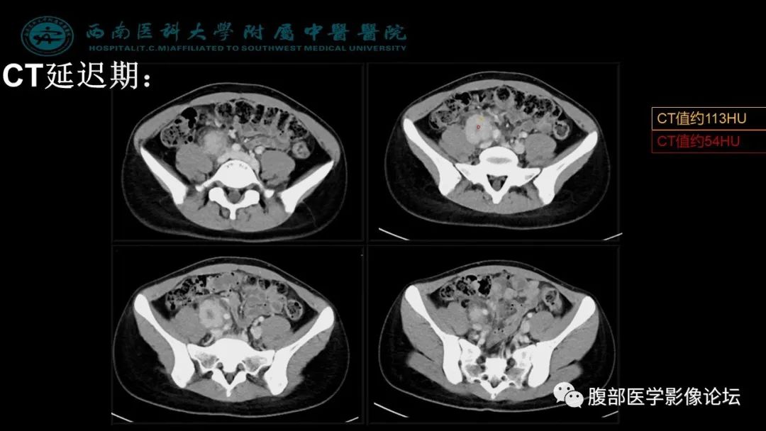 【病例】髂窝淋巴结炎性假瘤1例CT及MR影像诊断