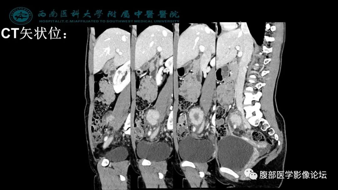 【病例】髂窝淋巴结炎性假瘤1例CT及MR影像诊断