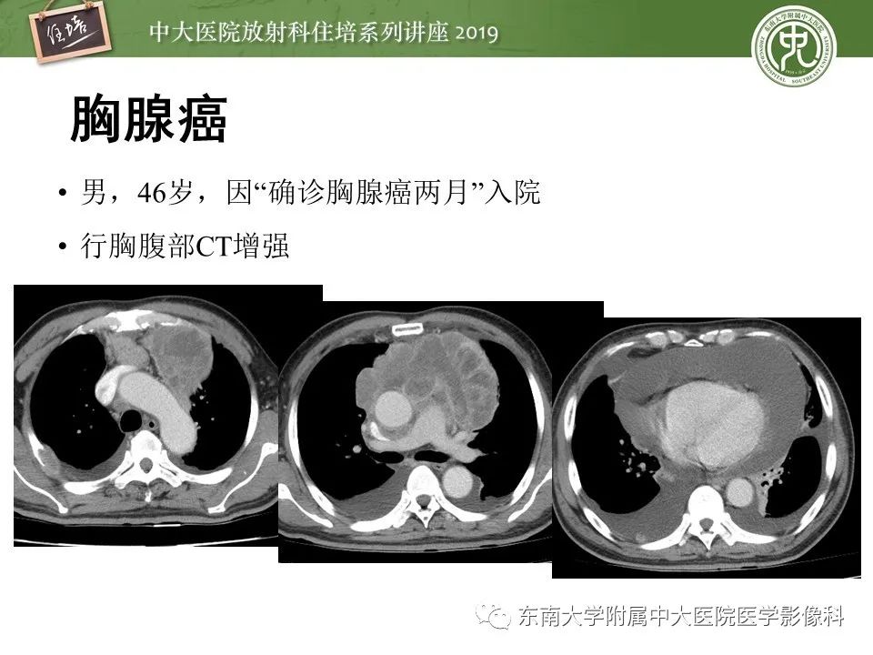 【PPT】胸腺上皮性肿瘤的影像诊断及鉴别