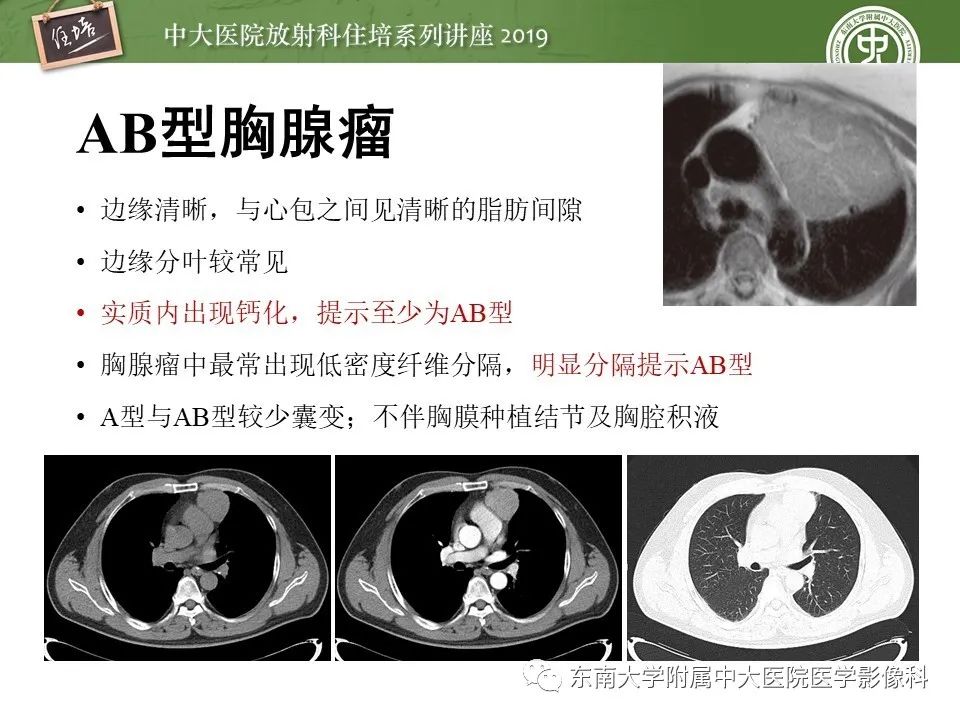 【PPT】胸腺上皮性肿瘤的影像诊断及鉴别