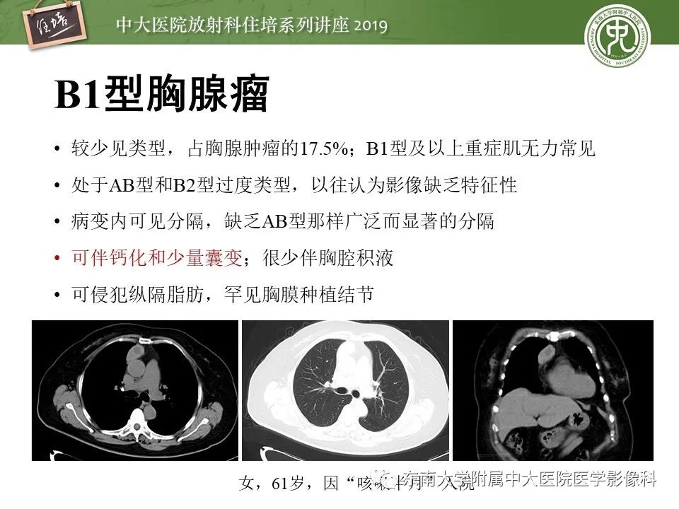 【PPT】胸腺上皮性肿瘤的影像诊断及鉴别
