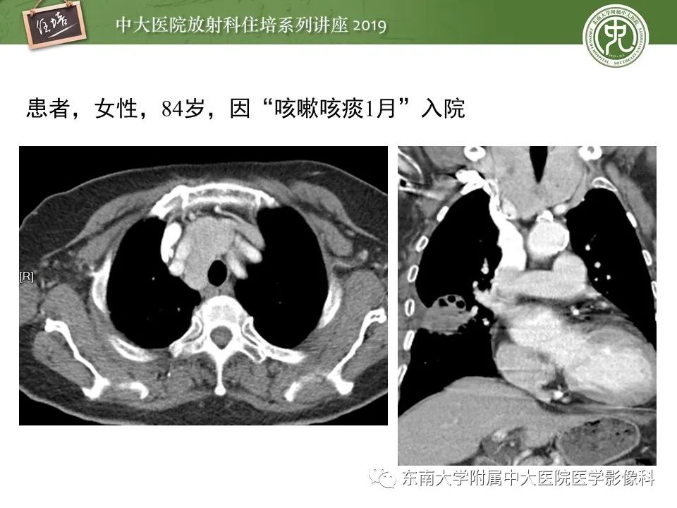 【PPT】胸腺上皮性肿瘤的影像诊断及鉴别