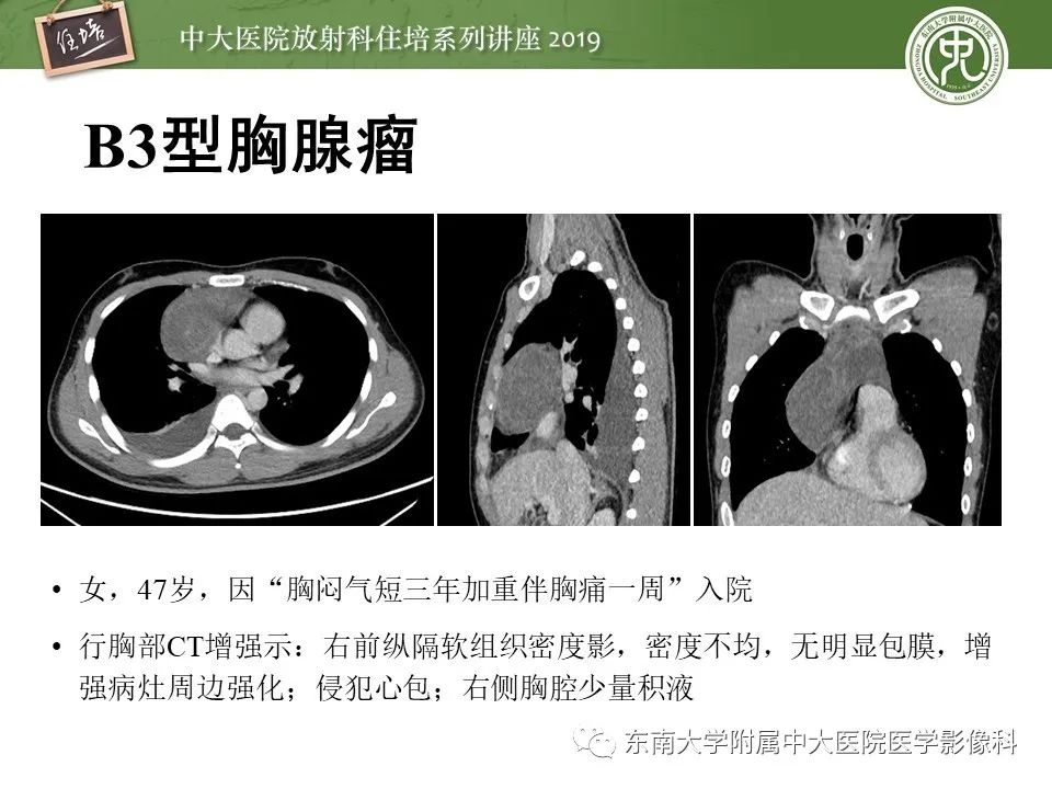【PPT】胸腺上皮性肿瘤的影像诊断及鉴别