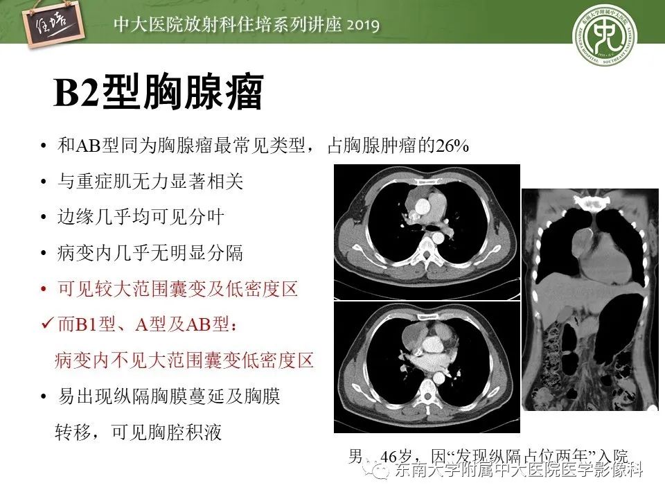 【PPT】胸腺上皮性肿瘤的影像诊断及鉴别