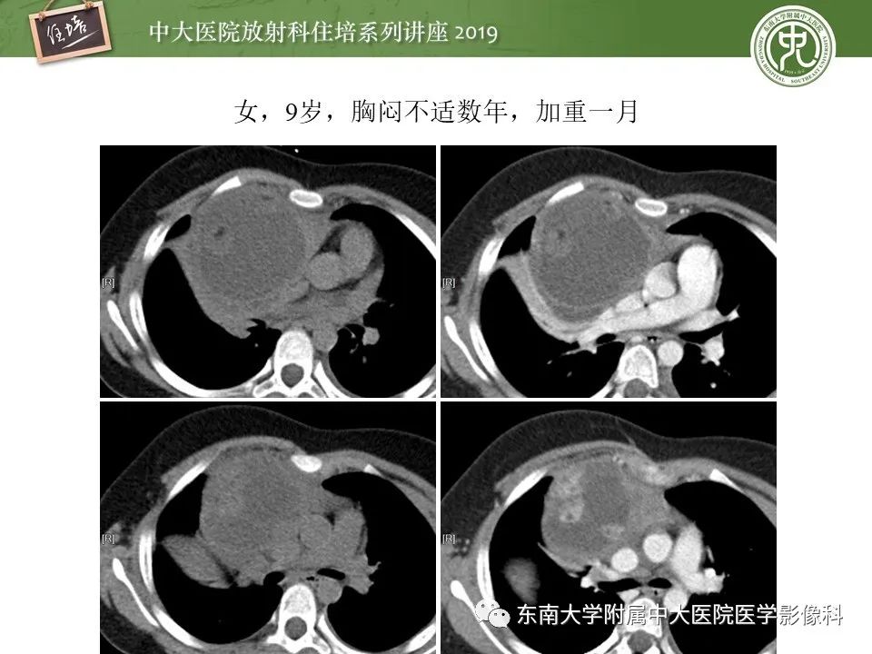 【PPT】胸腺上皮性肿瘤的影像诊断及鉴别