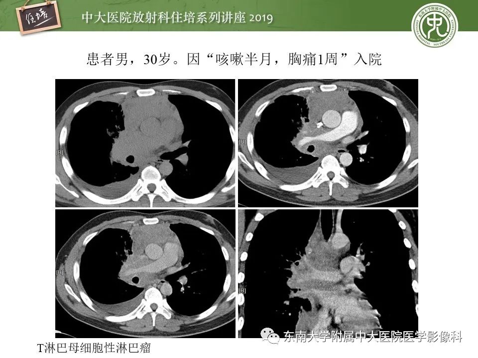 【PPT】胸腺上皮性肿瘤的影像诊断及鉴别