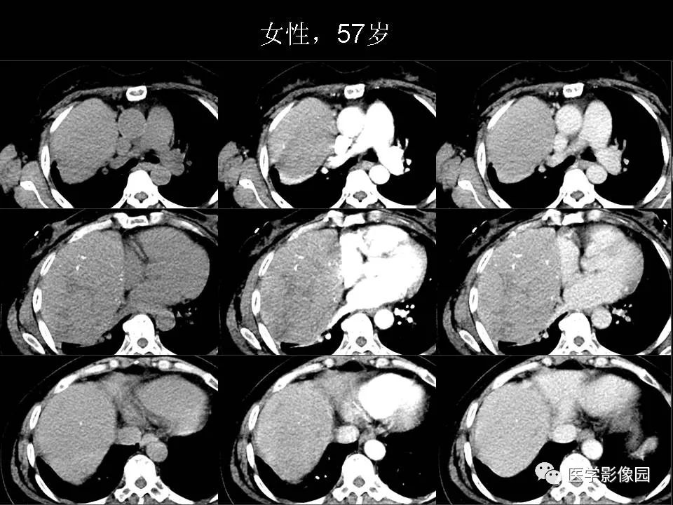 【PPT】胸腺类癌CT诊断与鉴别诊断