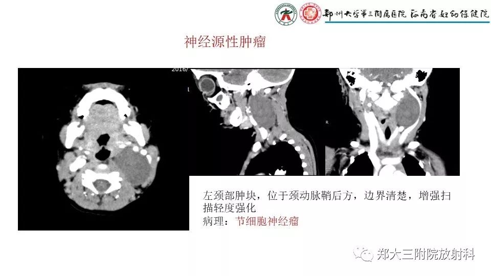 【病例】异位胸腺1例CT影像