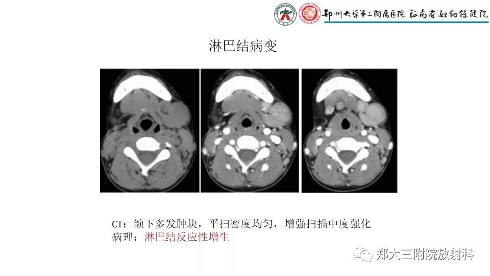 【病例】异位胸腺1例CT影像