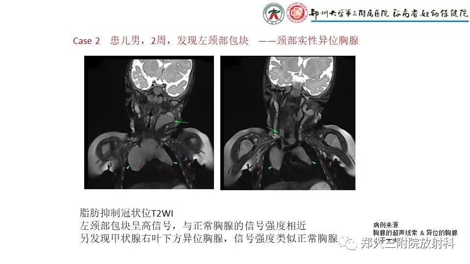 【病例】异位胸腺1例CT影像