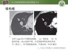 肺结节的影像诊断及临床管理
