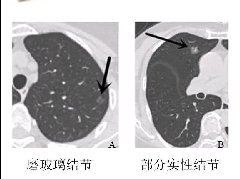 肺结节的影像诊断及临床管理