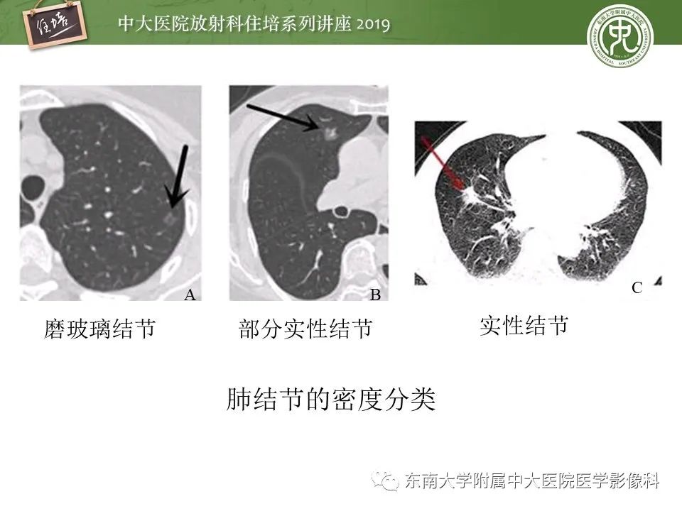 【PPT】肺结节的影像诊断及临床管理