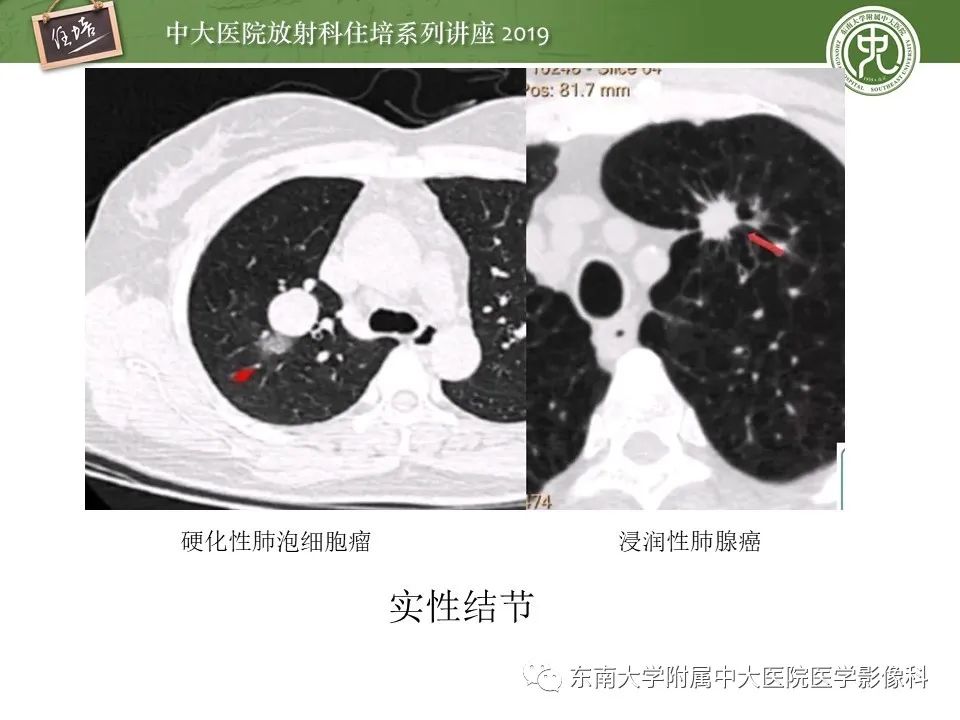 【PPT】肺结节的影像诊断及临床管理