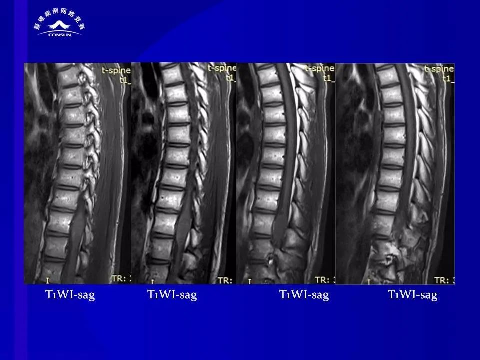 【病例】脊髓节细胞胶质瘤1例MR影像解析 【病例】脊髓节细胞胶质瘤1例MR影像解析
